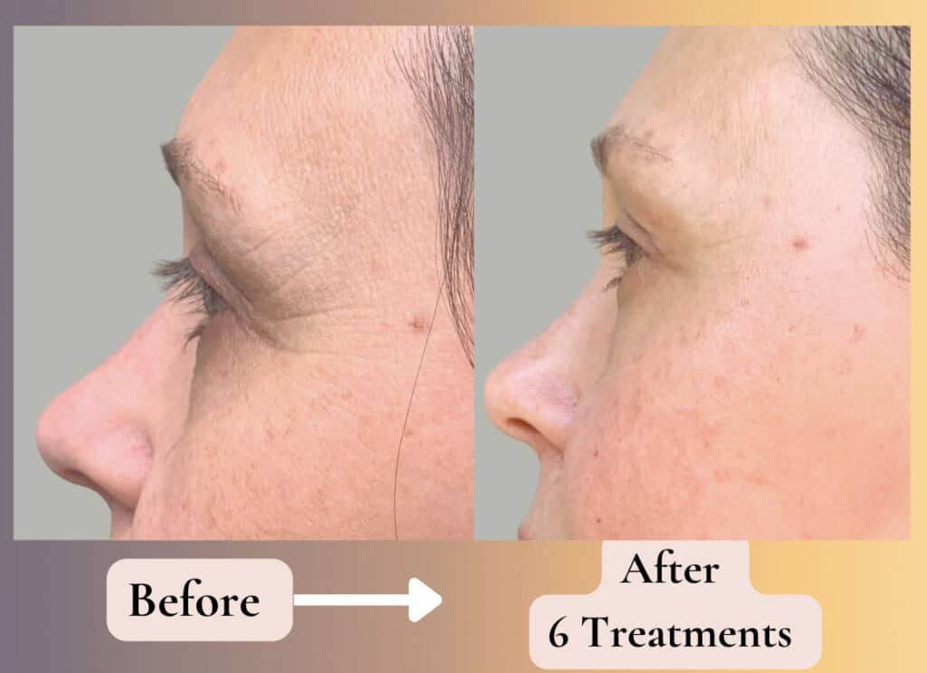 Before and After 6 "Complete Renewal" Treatments - side view